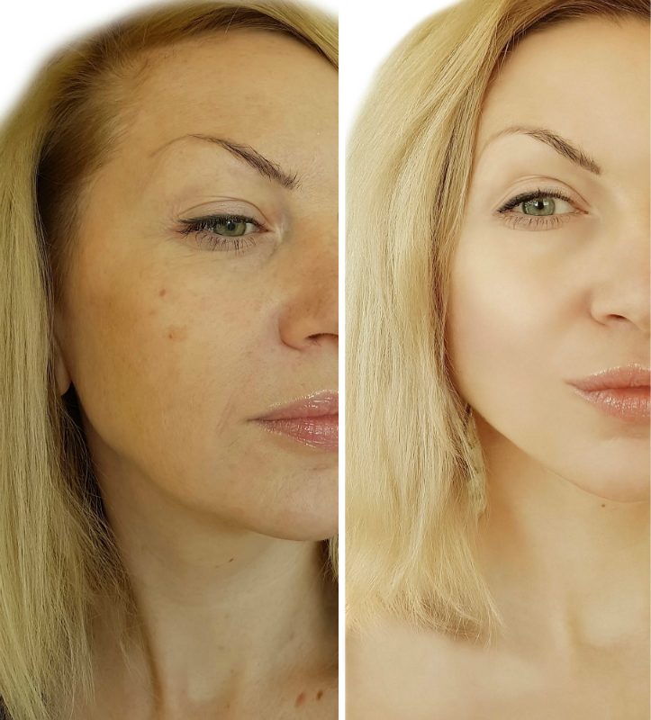 Fight the Aging Process and Get Dramatic Results With a Thread Neck Lift
