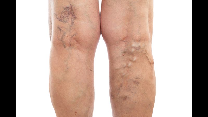 What to Expect from Varicose Vein Treatment in Bensalem, PA