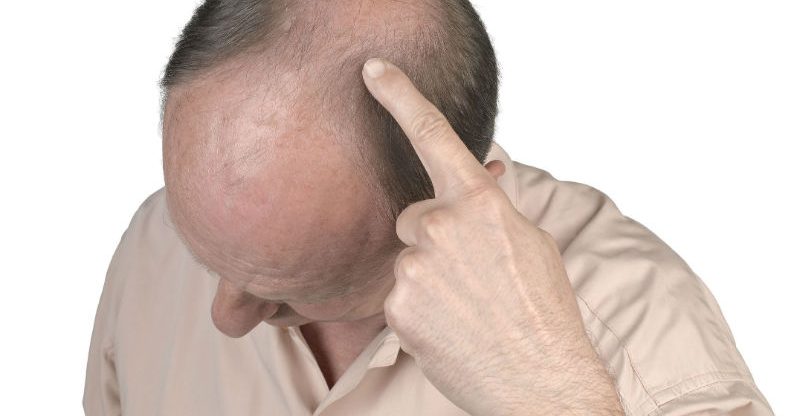 A Brief Overview of the Hair Transplant Procedure in Washington, DC