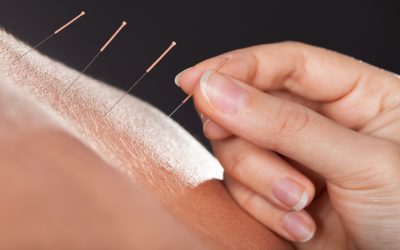 Transform Your Wellbeing Using Acupuncture For Anxiety, Berkeley, CA, Solutions